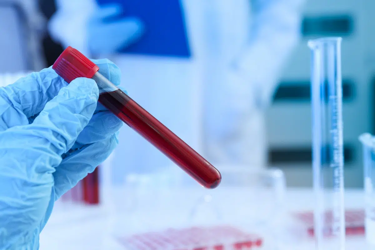 Blood Test During a DUI